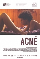 Acné
